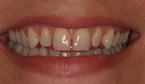 Before tooth image at PHD
